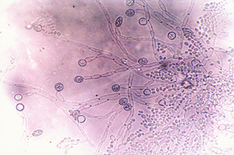 Соскоб на мицелий. Грибок кандида под микроскопом. Мицелий кандида. Грибы кандида под микроскопом. Мицелий гриба микроскопия.