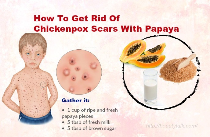 How To Get Rid Of Chickenpox Scars 